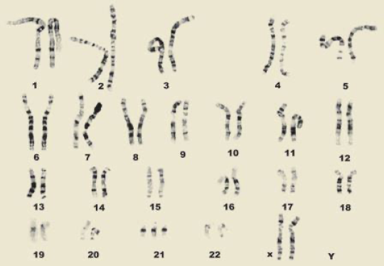 Trisomy 21 Karyotype Female
