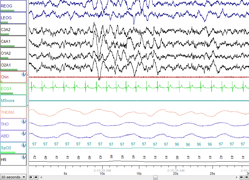 Polysomnography